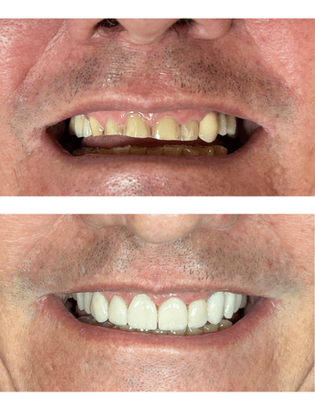 Reabilitação do sorriso com laminados, Laminados cerâmicos