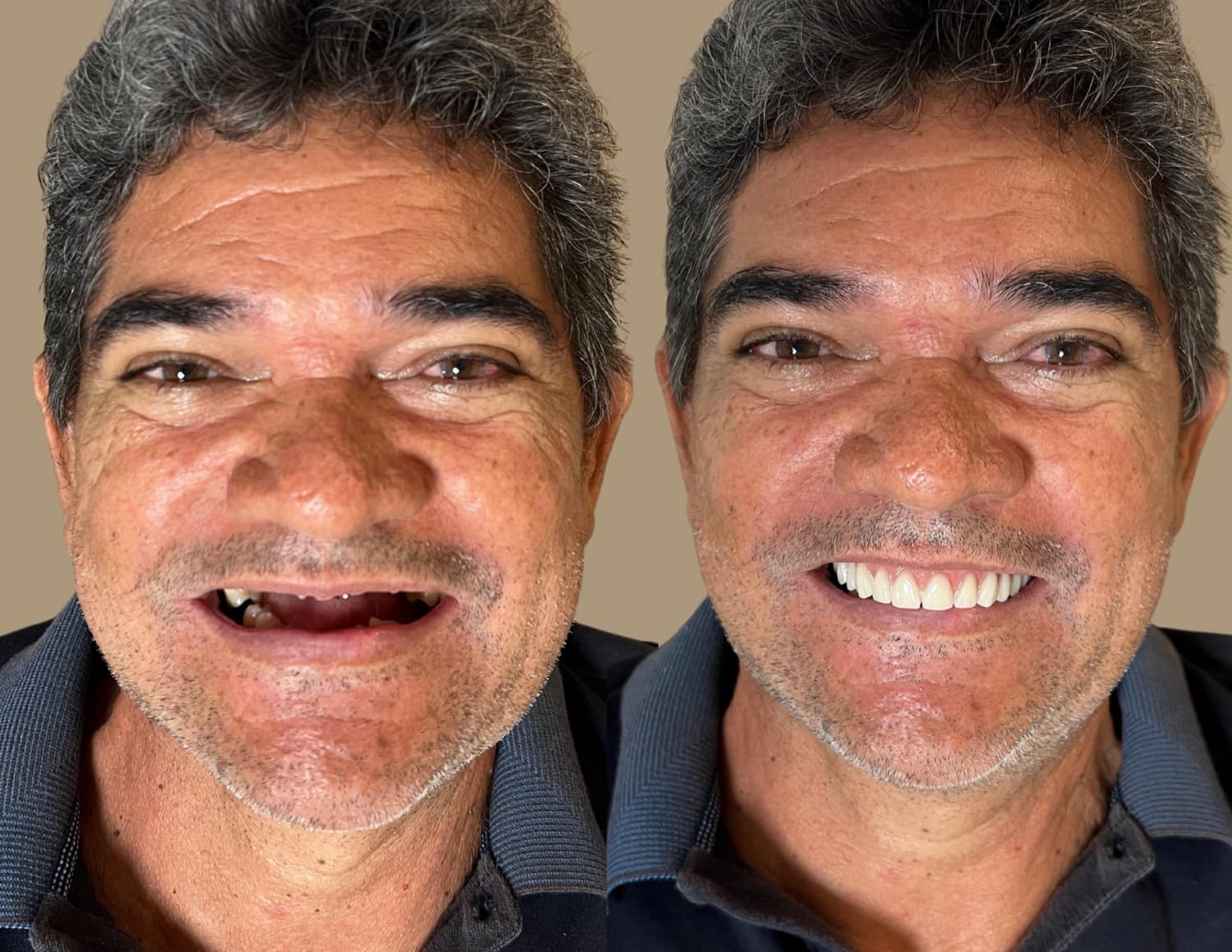 Prótese protocolo